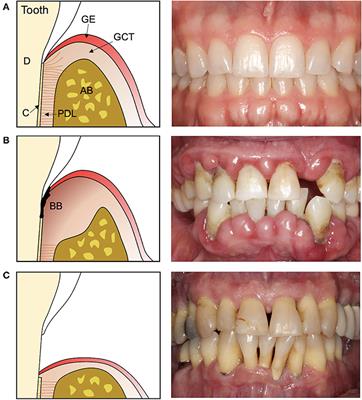 Periodontal Wound Healing and Regeneration: Insights for Engineering New Therapeutic Approaches